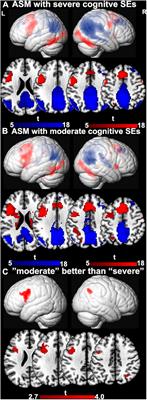 Effect of Anti-seizure Medications on Functional Anatomy of Language: A Perspective From Language Functional Magnetic Resonance Imaging
